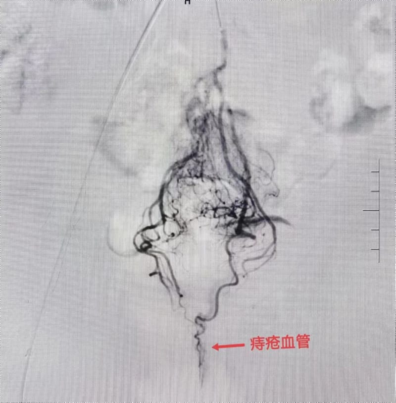 广东省介入栓塞治疗痔疮